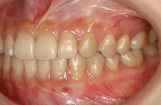 予防歯科 症例1